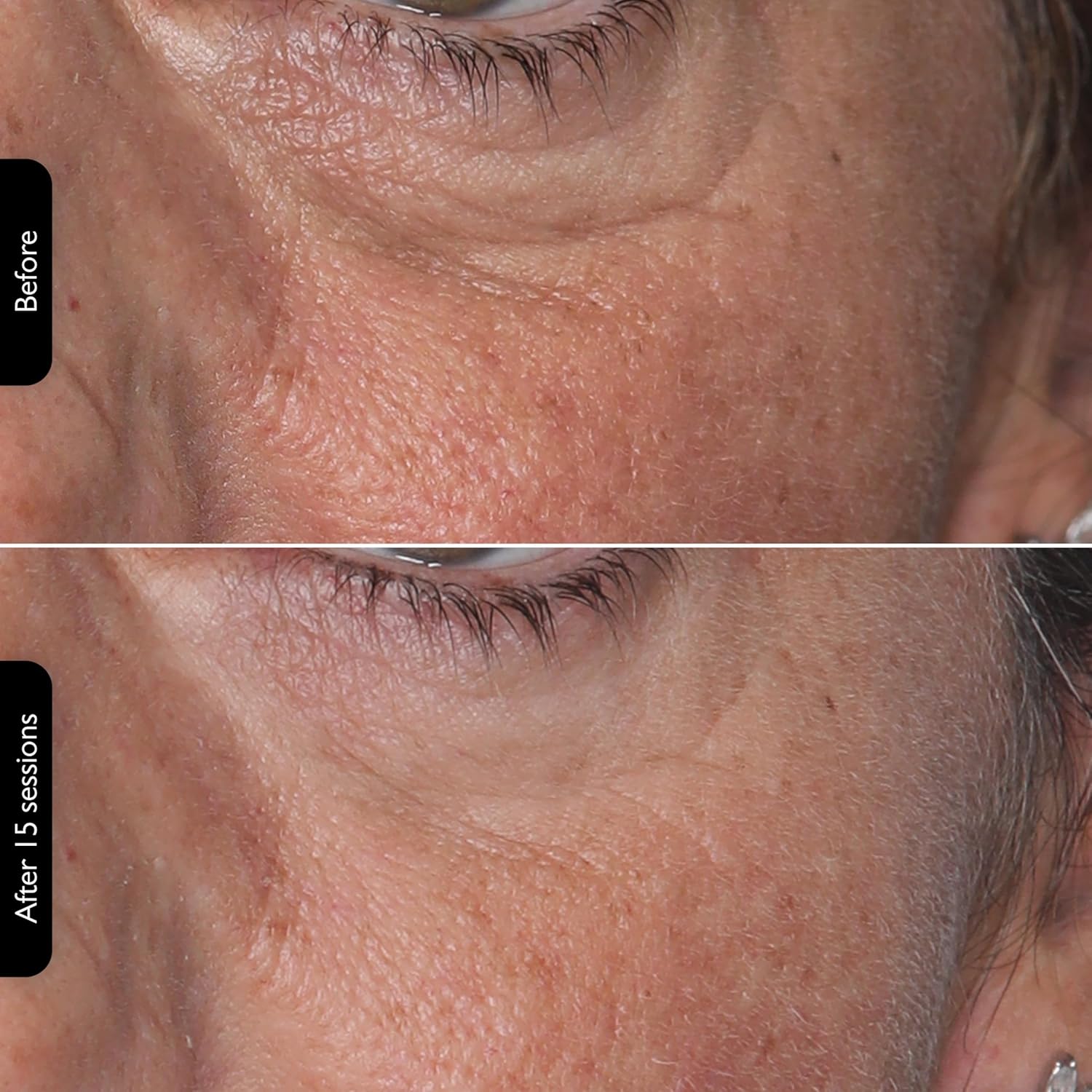 LEDMask | Amélioration de la peau avec la technologie LED